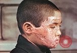 Image of clothing lines on atomic bomb burn victim Hiroshima Japan, 1946, second 19 stock footage video 65675060696