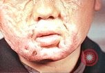 Image of clothing lines on atomic bomb burn victim Hiroshima Japan, 1946, second 20 stock footage video 65675060696