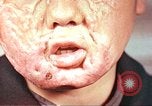 Image of clothing lines on atomic bomb burn victim Hiroshima Japan, 1946, second 21 stock footage video 65675060696