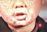 Image of clothing lines on atomic bomb burn victim Hiroshima Japan, 1946, second 22 stock footage video 65675060696