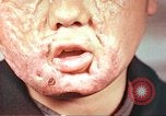 Image of clothing lines on atomic bomb burn victim Hiroshima Japan, 1946, second 23 stock footage video 65675060696