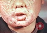 Image of clothing lines on atomic bomb burn victim Hiroshima Japan, 1946, second 24 stock footage video 65675060696