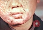 Image of clothing lines on atomic bomb burn victim Hiroshima Japan, 1946, second 25 stock footage video 65675060696