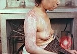 Image effets de position sur victime de la bombe atomique Hiroshima au Japon, 1946, de la seconde 15 séquences d'archives historiques vidéo 65675060697