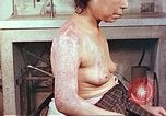 Image effets de position sur victime de la bombe atomique Hiroshima au Japon, 1946, de la seconde 16 séquences d'archives historiques vidéo 65675060697
