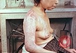 Image effets de position sur victime de la bombe atomique Hiroshima au Japon, 1946, de la seconde 17 séquences d'archives historiques vidéo 65675060697