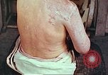 Image effets de position sur victime de la bombe atomique Hiroshima au Japon, 1946, de la seconde 20 séquences d'archives historiques vidéo 65675060697