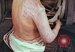 Image effets de position sur victime de la bombe atomique Hiroshima au Japon, 1946, de la seconde 22 séquences d'archives historiques vidéo 65675060697