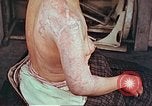 Image effets de position sur victime de la bombe atomique Hiroshima au Japon, 1946, de la seconde 23 séquences d'archives historiques vidéo 65675060697