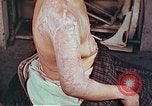 Image effets de position sur victime de la bombe atomique Hiroshima au Japon, 1946, de la seconde 24 séquences d'archives historiques vidéo 65675060697
