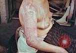 Image effets de position sur victime de la bombe atomique Hiroshima au Japon, 1946, de la seconde 25 séquences d'archives historiques vidéo 65675060697