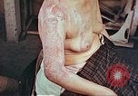 Image effets de position sur victime de la bombe atomique Hiroshima au Japon, 1946, de la seconde 26 séquences d'archives historiques vidéo 65675060697