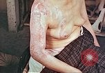 Image effets de position sur victime de la bombe atomique Hiroshima au Japon, 1946, de la seconde 27 séquences d'archives historiques vidéo 65675060697
