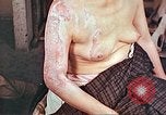 Image effets de position sur victime de la bombe atomique Hiroshima au Japon, 1946, de la seconde 28 séquences d'archives historiques vidéo 65675060697