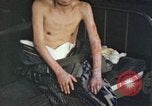 Image of Japanese patient Nagasaki Japan, 1946, second 43 stock footage video 65675060752