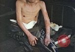 Image of Japanese patient Nagasaki Japan, 1946, second 44 stock footage video 65675060752