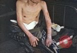 Image of Japanese patient Nagasaki Japan, 1946, second 47 stock footage video 65675060752