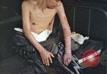 Image of Japanese patient Nagasaki Japan, 1946, second 50 stock footage video 65675060752