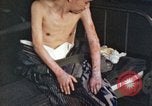 Image of Japanese patient Nagasaki Japan, 1946, second 52 stock footage video 65675060752
