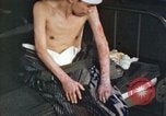 Image of Japanese patient Nagasaki Japan, 1946, second 54 stock footage video 65675060752