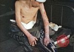 Image of Japanese patient Nagasaki Japan, 1946, second 56 stock footage video 65675060752