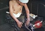 Image of Japanese patient Nagasaki Japan, 1946, second 59 stock footage video 65675060752