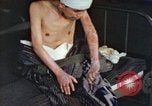 Image of Japanese patient Nagasaki Japan, 1946, second 60 stock footage video 65675060752