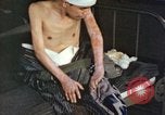 Image of Japanese patient Nagasaki Japan, 1946, second 61 stock footage video 65675060752