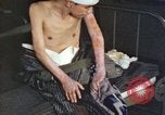 Image of Japanese patient Nagasaki Japan, 1946, second 62 stock footage video 65675060752