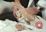 Image of Japanese patient Nagasaki Japan, 1946, second 14 stock footage video 65675060753