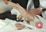 Image of Japanese patient Nagasaki Japan, 1946, second 15 stock footage video 65675060753