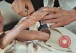 Image of Japanese patient Nagasaki Japan, 1946, second 22 stock footage video 65675060753