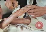 Image of Japanese patient Nagasaki Japan, 1946, second 23 stock footage video 65675060753