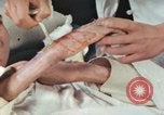 Image of Japanese patient Nagasaki Japan, 1946, second 24 stock footage video 65675060753