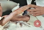 Image of Japanese patient Nagasaki Japan, 1946, second 25 stock footage video 65675060753