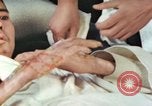 Image of Japanese patient Nagasaki Japan, 1946, second 26 stock footage video 65675060753