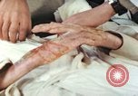 Image of Japanese patient Nagasaki Japan, 1946, second 28 stock footage video 65675060753