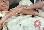 Image of Japanese patient Nagasaki Japan, 1946, second 30 stock footage video 65675060753