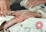 Image of Japanese patient Nagasaki Japan, 1946, second 31 stock footage video 65675060753