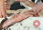 Image of Japanese patient Nagasaki Japan, 1946, second 32 stock footage video 65675060753