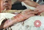 Image of Japanese patient Nagasaki Japan, 1946, second 33 stock footage video 65675060753