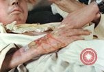 Image of Japanese patient Nagasaki Japan, 1946, second 34 stock footage video 65675060753