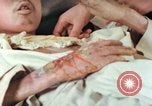 Image of Japanese patient Nagasaki Japan, 1946, second 35 stock footage video 65675060753