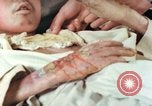 Image of Japanese patient Nagasaki Japan, 1946, second 36 stock footage video 65675060753