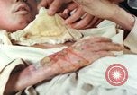 Image of Japanese patient Nagasaki Japan, 1946, second 37 stock footage video 65675060753