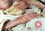Image of Japanese patient Nagasaki Japan, 1946, second 38 stock footage video 65675060753