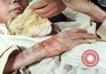 Image of Japanese patient Nagasaki Japan, 1946, second 39 stock footage video 65675060753