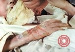 Image of Japanese patient Nagasaki Japan, 1946, second 40 stock footage video 65675060753