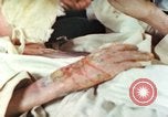 Image of Japanese patient Nagasaki Japan, 1946, second 41 stock footage video 65675060753