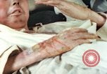 Image of Japanese patient Nagasaki Japan, 1946, second 42 stock footage video 65675060753
